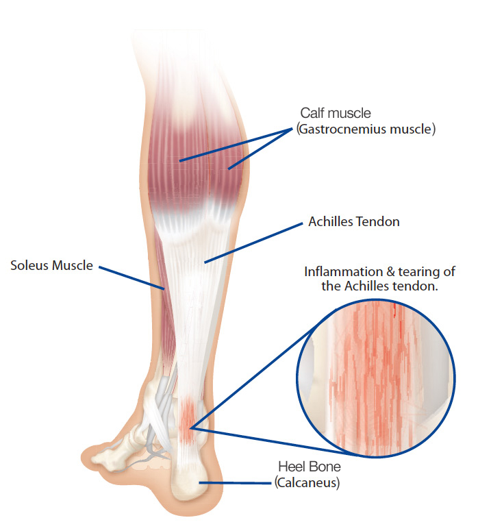 Pictures Of Tendonitis 92